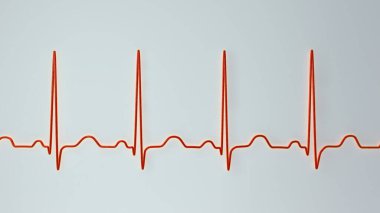 Elektrokardiyogramın detaylı bir 3D çizimi sinüs taşikardisi gösteriyor. Kalp ritmi normal kalp ritmi 90-100 bpm 'in üst sınırından daha yüksek..