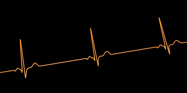 副徐脈を示す心電図の詳細な3Dイラスト 副徐脈から発生する遅い心拍数によって特徴付けられる状態 通常以下60分あたりのビート — ストック写真