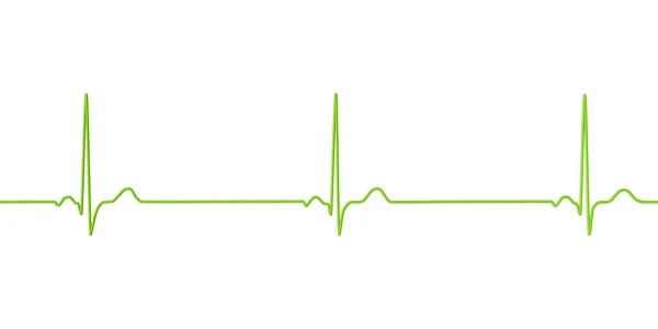 Részletes Illusztráció Egy Elektrokardiogram Megjelenítő Sinus Bradycardia Olyan Állapot Jellemzi — Stock Fotó