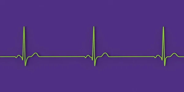Een Gedetailleerde Illustratie Van Een Elektrocardiogram Met Sinus Bradycardie Een — Stockfoto
