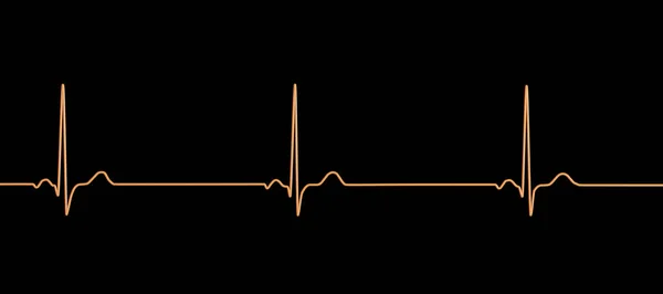 一个显示窦性心律失常的详细的三维心电图 其特点是窦性节律性心率缓慢 通常低于每分钟60下 — 图库照片