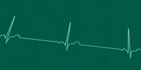 Detailní Ilustrace Elektrokardiogramu Zobrazujícího Sinusovou Bradykardii Stav Charakterizovaný Pomalou Srdeční — Stock fotografie