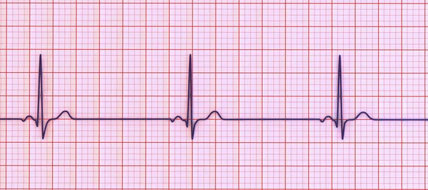 Een Gedetailleerde Illustratie Van Een Elektrocardiogram Met Sinus Bradycardie Een — Stockfoto