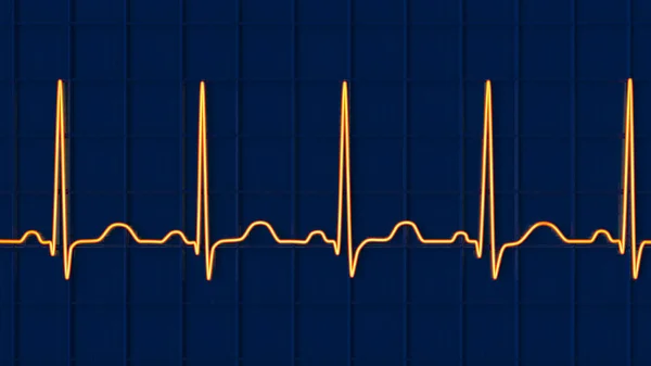 Detaillierte Illustration Eines Elektrokardiogramm Ekgs Zur Darstellung Der Sinus Tachykardie — Stockfoto
