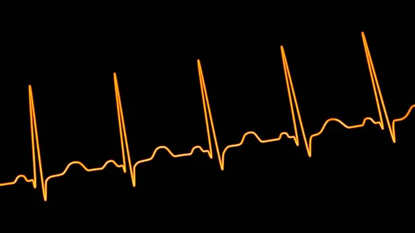 Una Ilustración Detallada Electrocardiograma Ecg Que Muestra Taquicardia Sinusal Ritmo — Foto de Stock