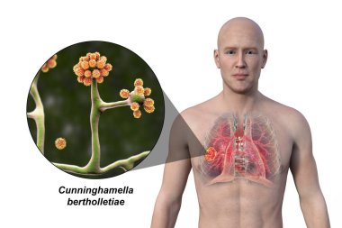 Şeffaf derisi olan bir adamın üst kısmının 3 boyutlu fotorealistik çizimi, Cunninghamella bertholletiae mantarlarının yakın görüntüsü ile akciğer mukozis lezyonunu ortaya çıkarıyor..