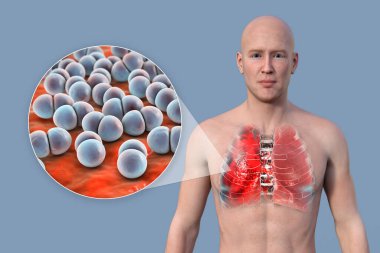 Üç boyutlu fotorealistik bir illüstrasyon şeffaf derili bir adamın üst yarısını gösteriyor, akciğerleri zatürreeden etkilenmiş, ve Streptococcus pneumoniae bakterisinin yakından görüntüsünü ortaya çıkarıyor..