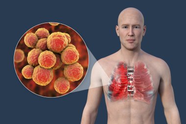 Şeffaf derisi olan bir adamın üst yarısını gösteren 3 boyutlu bir fotorealistik çizim akciğerlerin zatürreeden etkilendiğini ve Staphylococcus aureus bakterisinin yakın plan görüntüsünü ortaya çıkarıyor..