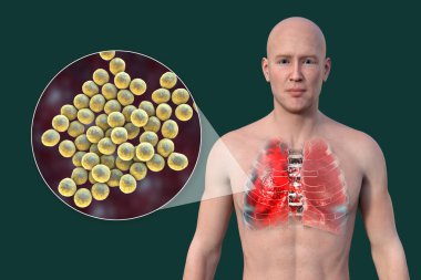 Şeffaf derisi olan bir adamın üst yarısını gösteren 3 boyutlu bir fotorealistik çizim akciğerlerin zatürreeden etkilendiğini ve Staphylococcus aureus bakterisinin yakın plan görüntüsünü ortaya çıkarıyor..