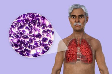 Şeffaf derili bir adamın üst kısmının 3 boyutlu bir çizimi sigara içen adamın akciğerlerinin durumunu ve sigara içmekten etkilenen akciğerlerin mikro-grafik görüntüsünü ortaya çıkarıyor..
