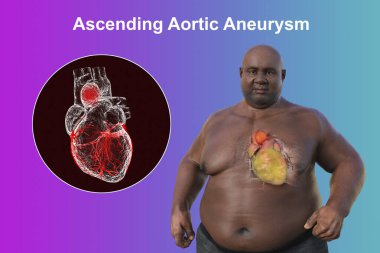 3D bilimsel illüstrasyon, saydam derili obez bir adamı, yükselen bir aort anevrizmasını, obezite ile yükselen aort anevrizmasının ilişkisini vurgulayan bir konsepti gözler önüne seriyor..