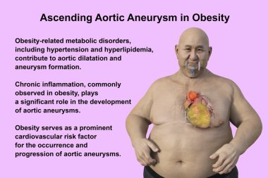 3D bilimsel illüstrasyon, saydam derili obez bir adamı, yükselen bir aort anevrizmasını, obezite ile yükselen aort anevrizmasının ilişkisini vurgulayan bir konsepti gözler önüne seriyor..