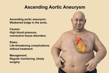 3D bilimsel illüstrasyon, saydam derili obez bir adamı, yükselen bir aort anevrizmasını, obezite ile yükselen aort anevrizmasının ilişkisini vurgulayan bir konsepti gözler önüne seriyor..