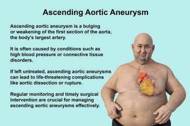 3D bilimsel illüstrasyon, saydam derili obez bir adamı, yükselen bir aort anevrizmasını, obezite ile yükselen aort anevrizmasının ilişkisini vurgulayan bir konsepti gözler önüne seriyor..