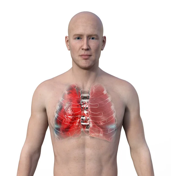 图为一个皮肤透明的男子上半身的3D照片 显示了肺部感染肺炎的情况 — 图库照片