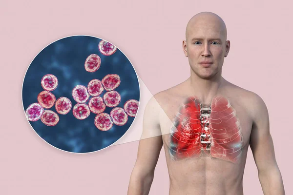 一个3D的照片逼真地展示了一个皮肤透明的男人上半身 揭示了肺部感染肺炎的情况 以及金黄色葡萄球菌的特写 — 图库照片