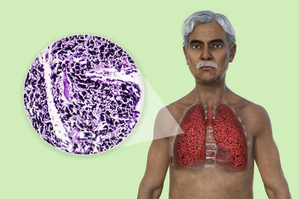 Ilustracja Górnej Połowy Człowieka Przezroczystą Skórą Ukazująca Stan Płuc Palacza — Zdjęcie stockowe