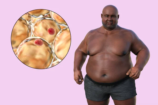 Illustrazione Medica Raffigurante Uomo Sovrappeso Con Una Visione Ravvicinata Degli — Foto Stock