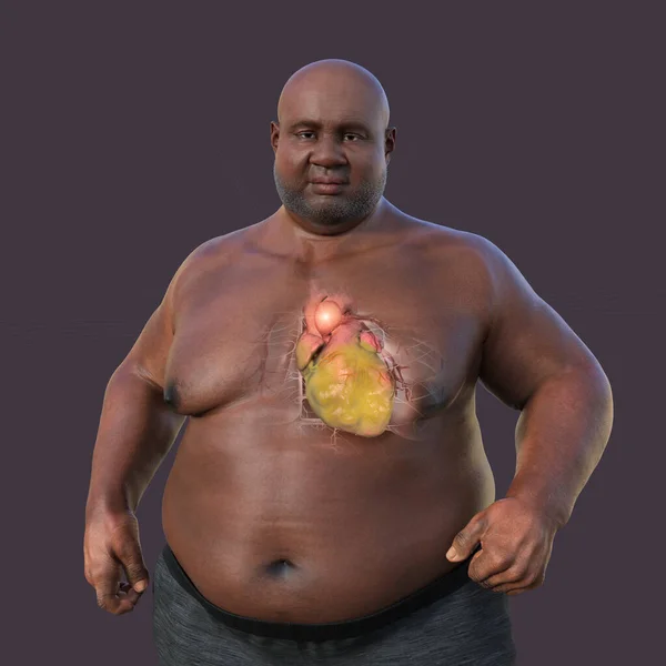 Illustrazione Scientifica Raffigurante Uomo Obeso Con Pelle Trasparente Che Rivela — Foto Stock