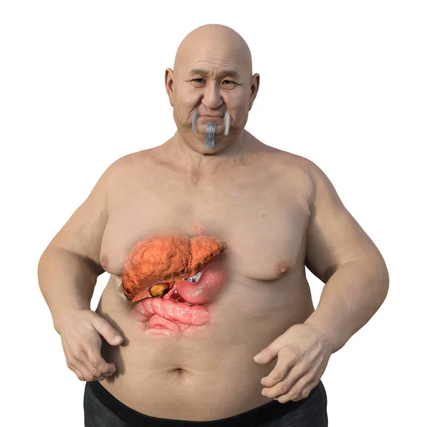 Μια Τρισδιάστατη Ιατρική Απεικόνιση Υπέρβαρο Άνδρα Διάφανο Δέρμα Που Αναδεικνύει — Φωτογραφία Αρχείου