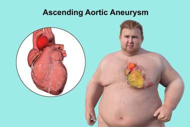 Saydam derisi olan obez bir adamı, yükselen bir aort anevrizmasını, obezite ile yükselen aort anevrizmasının ilişkisini vurgulayan bir konsepti gözler önüne seren üç boyutlu bilimsel bir çizim..