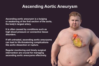 Saydam derisi olan obez bir adamı, yükselen bir aort anevrizmasını, obezite ile yükselen aort anevrizmasının ilişkisini vurgulayan bir konsepti gözler önüne seren üç boyutlu bilimsel bir çizim..