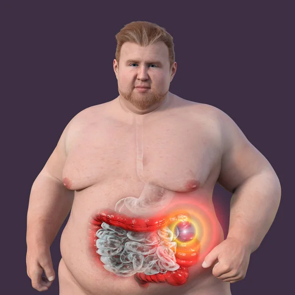 Egy Túlsúlyos Ember Átlátszó Bőrrel Bemutatva Emésztőrendszert Kiemelve Vastagbél Görcsök — Stock Fotó