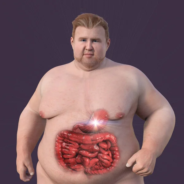 Una Dettagliata Illustrazione Medica Uomo Sovrappeso Con Pelle Trasparente Che — Foto Stock