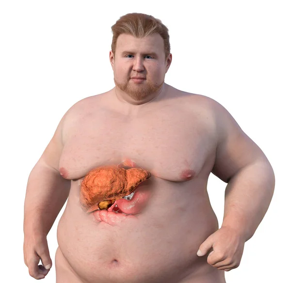 Medical Illustration Featuring Overweight Man Transparent Skin Showcasing Liver Highlighting — Stock Photo, Image