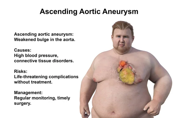 A 3D scientific illustration depicting an obese man with transparent skin, revealing an ascending aortic aneurysm, a concept highlighting the association of ascending aortic aneurysm with obesity.