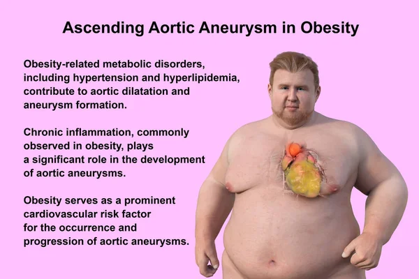 A 3D scientific illustration depicting an obese man with transparent skin, revealing an ascending aortic aneurysm, a concept highlighting the association of ascending aortic aneurysm with obesity.