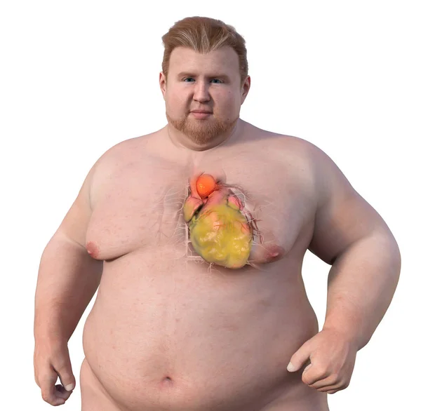 Egy Tudományos Illusztráció Ábrázolja Elhízott Férfi Átlátszó Bőr Felfedve Egy — Stock Fotó