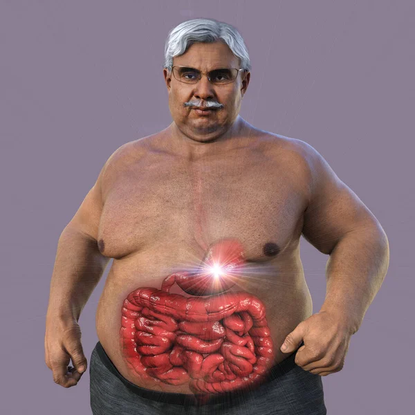 一个3D的科学图解描述了一个肥胖老人 他的皮肤透明 肠子暴露 突出了肥胖病人的消化系统紊乱 — 图库照片