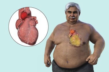 3D bilimsel illüstrasyon, şeffaf derisi olan yaşlı obez bir adamı, yükselen bir aort anevrizmasını, obezite ile yükselen aort anevrizmasını vurgulayan bir konsepti gözler önüne seriyor..