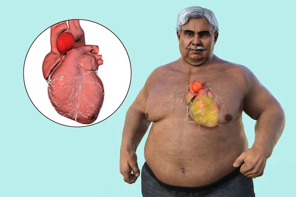 Scientific Illustration Depicting Senior Obese Man Transparent Skin Revealing Ascending — Stock Photo, Image