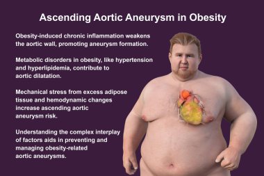 Saydam derisi olan obez bir adamı, yükselen bir aort anevrizmasını, obezite ile yükselen aort anevrizmasının ilişkisini vurgulayan bir konsepti gözler önüne seren üç boyutlu bilimsel bir çizim..