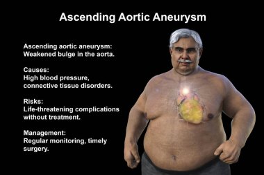 3D bilimsel illüstrasyon, şeffaf derisi olan yaşlı obez bir adamı, yükselen bir aort anevrizmasını, obezite ile yükselen aort anevrizmasını vurgulayan bir konsepti gözler önüne seriyor..