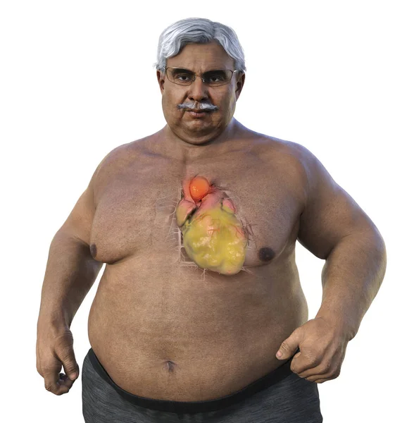 Scientific Illustration Depicting Senior Obese Man Transparent Skin Revealing Ascending — Stock Photo, Image
