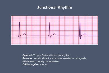 Electrocardiogram displaying a junctional rhythm, which occurs when the electrical signals in the heart originate from the atrioventricular junction instead of the sinoatrial node, 3D illustration. clipart