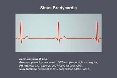 Sinüs düğümünden kaynaklanan yavaş kalp atışlarıyla karakterize edilen sinüs bradikardisini gösteren bir elektrokardiyogram, genellikle dakikada 60 'ın altında, 3 boyutlu illüstrasyon.