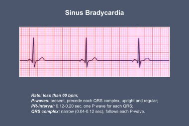 Sinüs düğümünden kaynaklanan yavaş kalp atışlarıyla karakterize edilen sinüs bradikardisini gösteren bir elektrokardiyogram, genellikle dakikada 60 'ın altında, 3 boyutlu illüstrasyon.