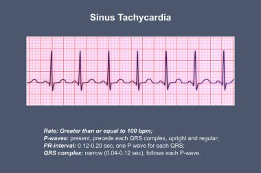 Elektrokardiyogram (ECG) sinüs taşikardisi gösteriyor. Normal kalp ritmi, yetişkinlerde 90-100 bpm 'nin üst sınırından daha yüksek. 3 boyutlu illüstrasyon..
