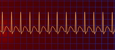 Supraventriküler taşikardide EKG. Ventriküllerin yukarısından başlayan hızlı bir kalp atışı çarpıntıya ve baş dönmesine neden oluyor. 3 boyutlu resimleme, T dalgalarında gizlenmiş dar QRS kompleksleri ve P dalgalarını gösteriyor.