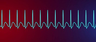 Supraventriküler taşikardide EKG. Ventriküllerin yukarısından başlayan hızlı bir kalp atışı çarpıntıya ve baş dönmesine neden oluyor. 3 boyutlu resimleme, T dalgalarında gizlenmiş dar QRS kompleksleri ve P dalgalarını gösteriyor.