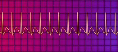 Supraventriküler taşikardide EKG. Ventriküllerin yukarısından başlayan hızlı bir kalp atışı çarpıntıya ve baş dönmesine neden oluyor. 3 boyutlu resimleme, T dalgalarında gizlenmiş dar QRS kompleksleri ve P dalgalarını gösteriyor.