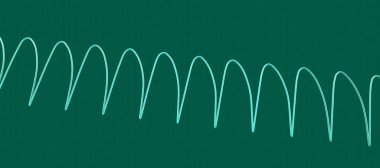 Ventriküler taşikardi: hızlı kalp ritmi kalp çarpıntısına, baş dönmesine, hayati tehlikesi olan semptomlara neden olur. ECG geniş QRS kompleksleri, 3 boyutlu illüstrasyon gösteriyor.