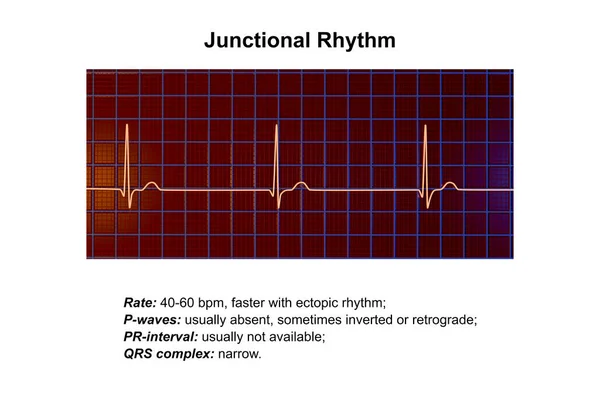 Elektrocardiogram Met Een Junctioneel Ritme Dat Optreedt Wanneer Elektrische Signalen — Stockfoto