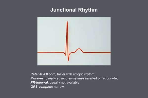 Elektrokardiogram Menunjukkan Irama Junctional Yang Terjadi Ketika Sinyal Listrik Jantung — Stok Foto