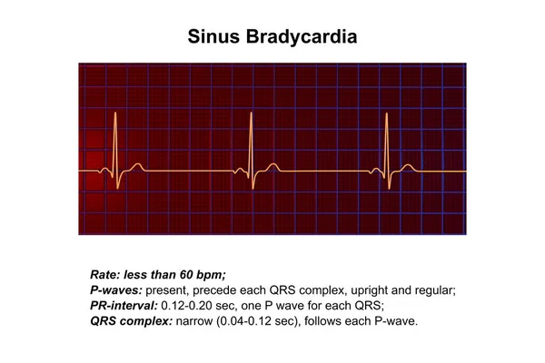 窦性心动过速一种显示窦性心动过缓的心电图 其特点是窦性结节的心率缓慢 通常低于每分钟60节拍 三维插图 — 图库照片