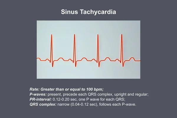 Electrocardiogram Ecg Displaying Sinus Tachycardia Regular Cardiac Rhythm Heart Rate — Stock Photo, Image